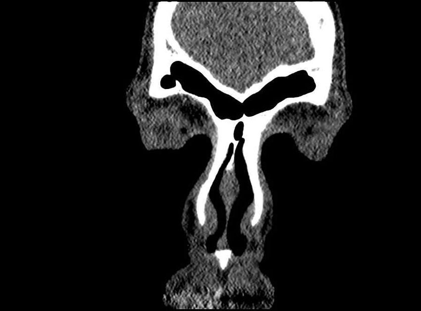 Arachnoid cyst- extremely large (Radiopaedia 68741-78450 Coronal bone window 74).jpg