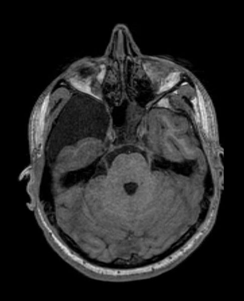 File:Arachnoid cyst- extremely large (Radiopaedia 68741-78451 Axial T1 23).jpg