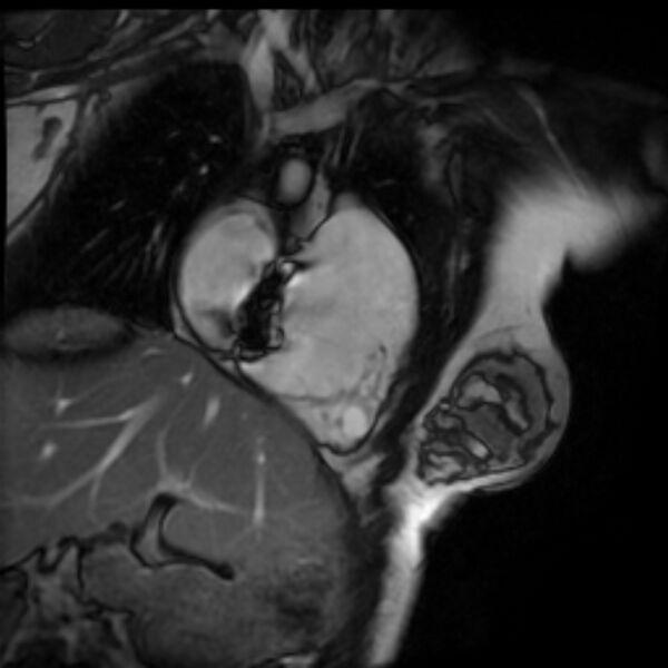 File:Arrhythmogenic right ventricular cardiomyopathy (Radiopaedia 87505-103850 2ch (RV) Cine SSFP 87).jpg
