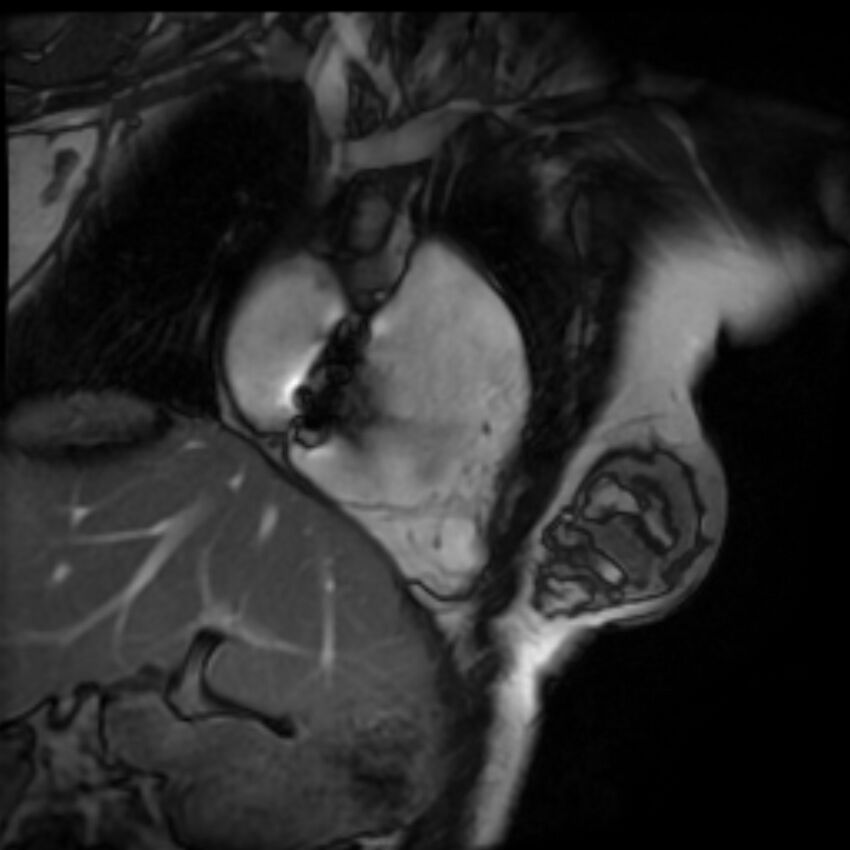 Arrhythmogenic right ventricular cardiomyopathy (Radiopaedia 87505-103850 2ch (RV) Cine SSFP 97).jpg