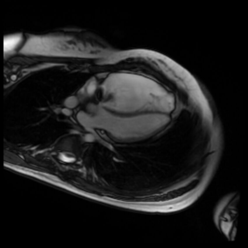 Arrhythmogenic right ventricular cardiomyopathy (Radiopaedia 87505-103850 4ch Cine SSFP 59).jpg