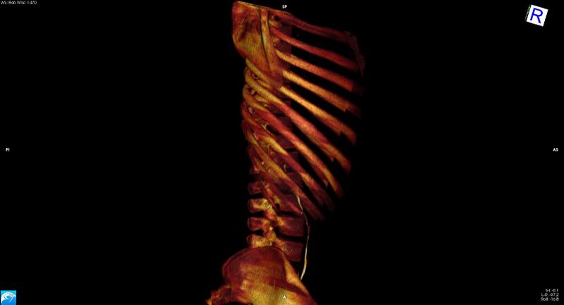 File:Arrow injury to the chest (Radiopaedia 75223-86321 3D bone 32).jpg