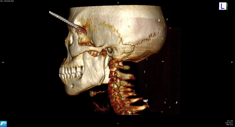 File:Arrow injury to the head (Radiopaedia 75266-86388 3D horizontal 24).jpg