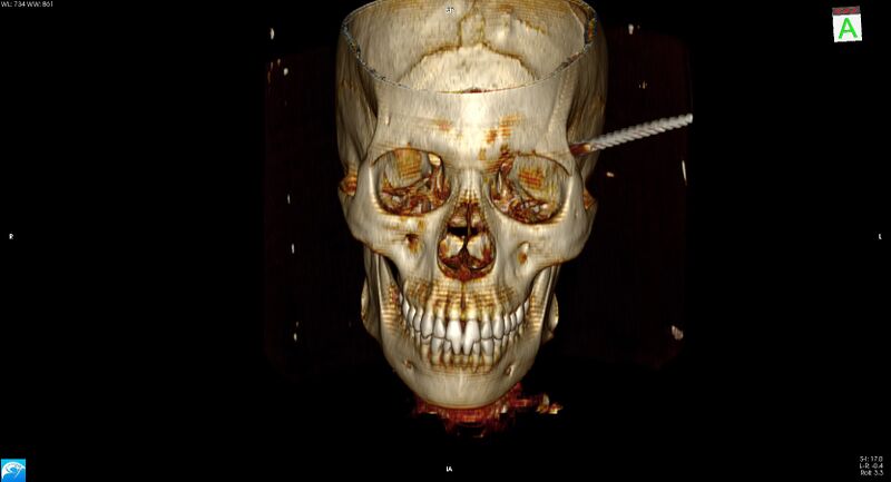 File:Arrow injury to the head (Radiopaedia 75266-86388 3D vertical 5).jpg