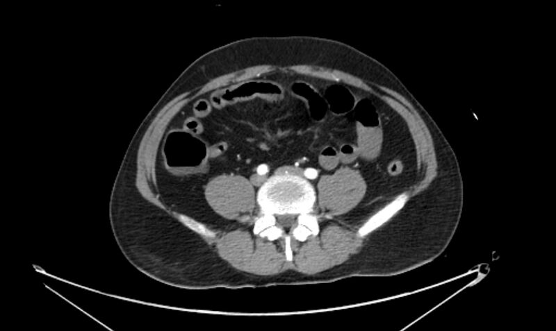 File:Arterial occlusive mesenteric ischemia (Radiopaedia 84641-100060 A 88).jpg