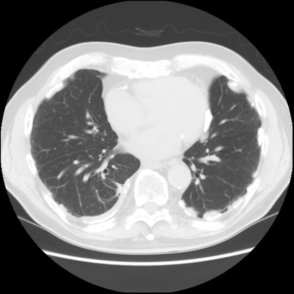 File:Asbestos-related pleural plaques (Radiopaedia 39069-41255 Axial lung window 47).jpg