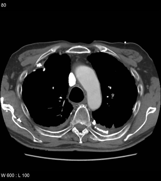 File:Asbestos related lung and pleural disease (Radiopaedia 14377-14301 D 16).jpg