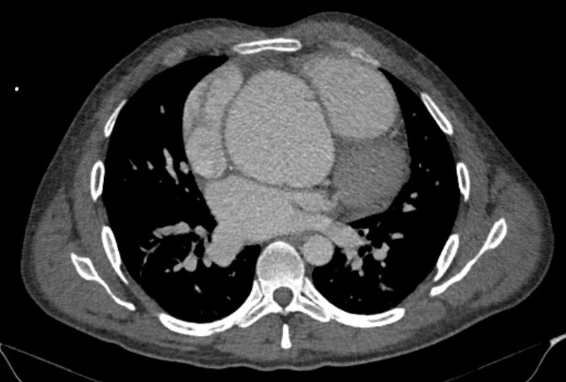 File:Ascending aortic aneurysm (Radiopaedia 86279-102297 C 34).jpg