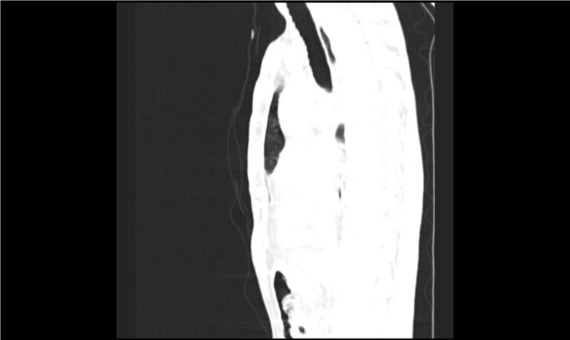 File:Aspergilloma (Radiopaedia 20788-20701 Sagittal lung window 11).jpg