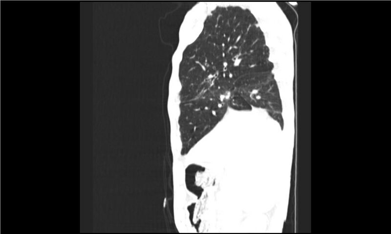 File:Aspergilloma (Radiopaedia 20788-20701 Sagittal lung window 15).jpg