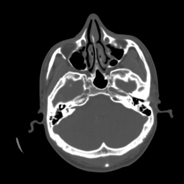 File:Asymptomatic occipital spur (Radiopaedia 87753-104201 Axial bone window 36).jpg