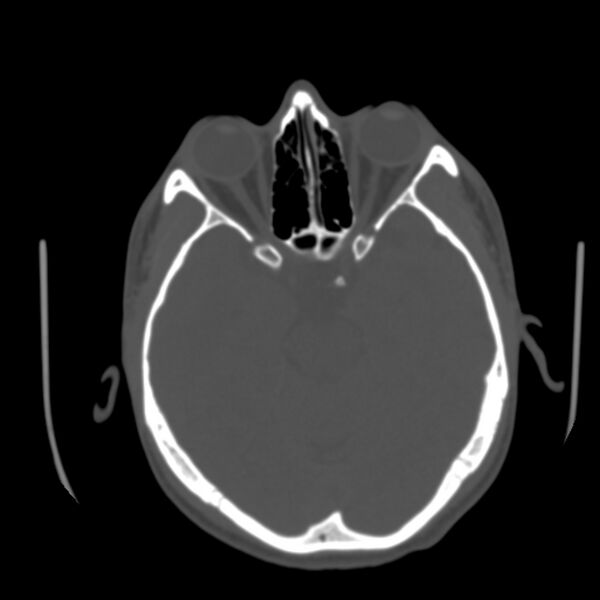 File:Asymptomatic occipital spur (Radiopaedia 87753-104201 Axial bone window 65).jpg