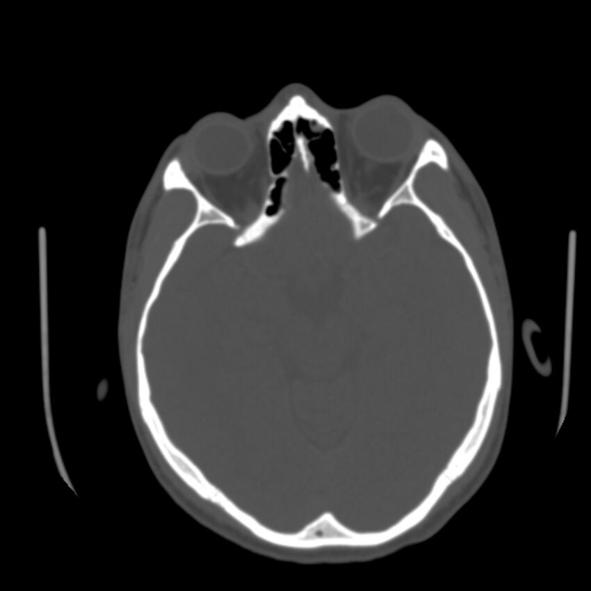 Asymptomatic occipital spur (Radiopaedia 87753-104201 Axial bone window 72).jpg