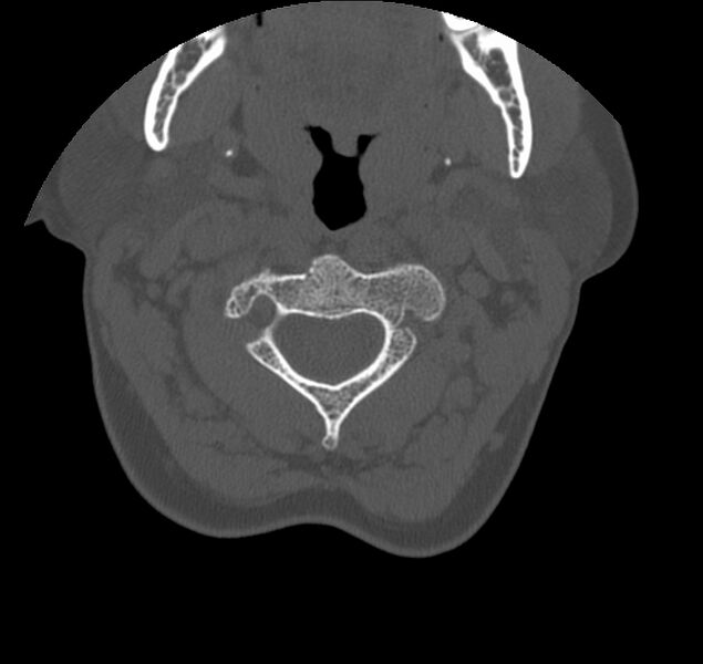 File:Atlanto-occipital assimilation with basilar invagination (Radiopaedia 70122-80188 Axial bone window 40).jpg