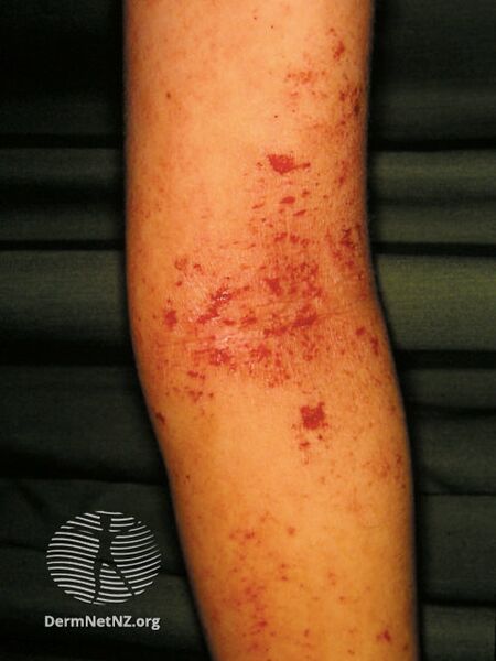 File:Atopic dermatitis (DermNet NZ dermatitis-flexural-eczema18).jpg