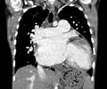 Atrial septal defect complicated by Eisenmenger syndrome (Radiopaedia 53707-59768 Coronal C+ CTPA 12).jpg