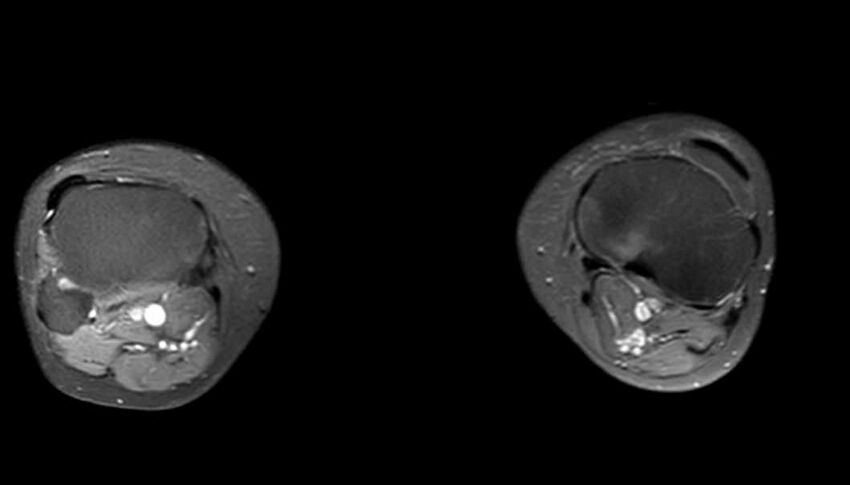 Atypical lipomatous tumor - thigh (Radiopaedia 68975-78734 Axial PD fat sat 1).jpg