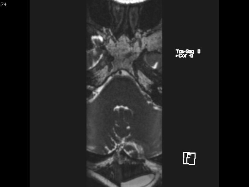 File:Atypical meningioma - intraosseous (Radiopaedia 64915-74572 Axial CISS 74).jpg