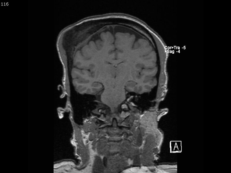 File:Atypical meningioma - intraosseous (Radiopaedia 64915-74572 Coronal T1 116).jpg