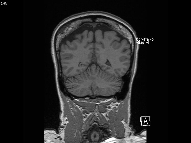 File:Atypical meningioma - intraosseous (Radiopaedia 64915-74572 Coronal T1 146).jpg