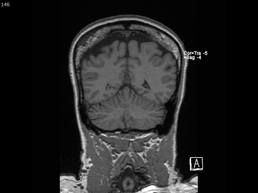 Atypical meningioma - intraosseous (Radiopaedia 64915-74572 Coronal T1 146).jpg