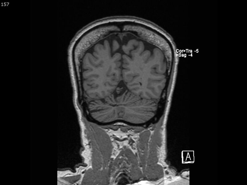 File:Atypical meningioma - intraosseous (Radiopaedia 64915-74572 Coronal T1 157).jpg