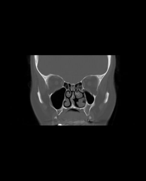 File:Automastoidectomy with labyrinthine fistula (Radiopaedia 84143-99411 Coronal non-contrast 34).jpg