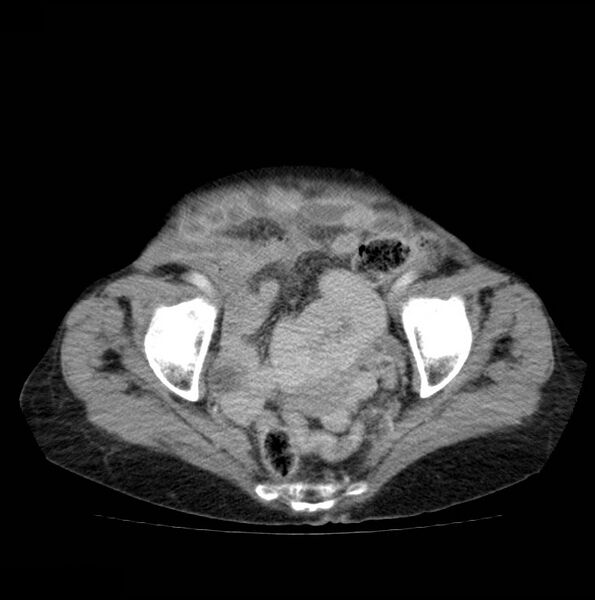 File:Autosomal dominant polycystic kidney disease (Radiopaedia 16777-16490 A 50).jpg