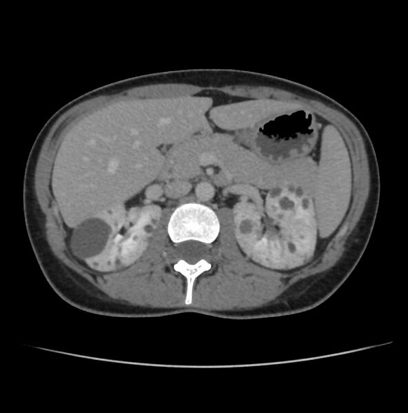 File:Autosomal dominant polycystic kidney disease - early onset (Radiopaedia 40734-43387 A 24).jpg