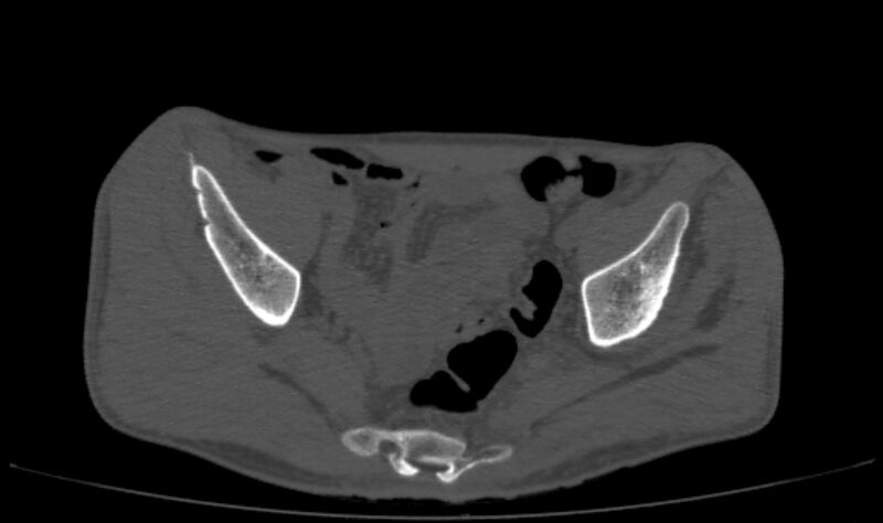 File:Avascular necrosis of the left hip (Radiopaedia 75068-86125 Axial bone window 2).jpg