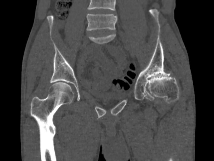 Avascular necrosis of the left hip (Radiopaedia 75068-86125 Coronal bone window 23).jpg