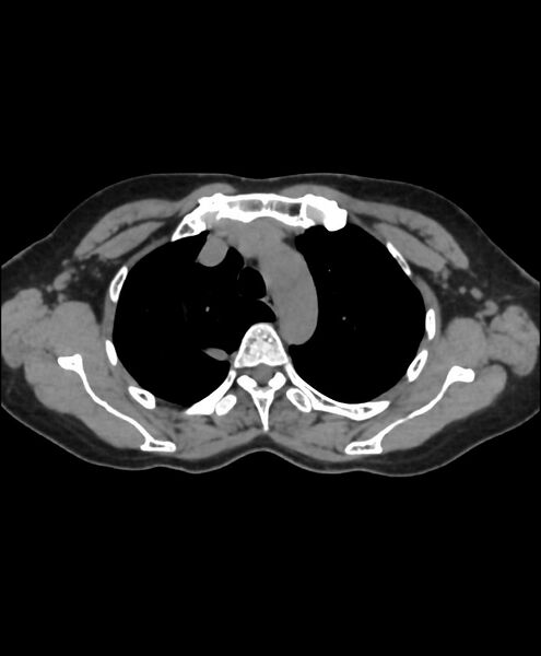 File:Azygos fissure and azygos lobe (Radiopaedia 41841-44832 Axial non-contrast 5).jpg