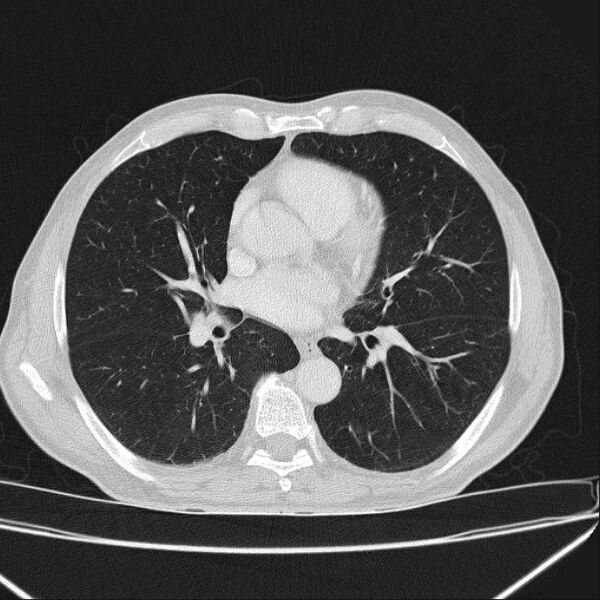 File:Azygos lobe (Radiopaedia 38259-40275 Axial lung window 45).jpg