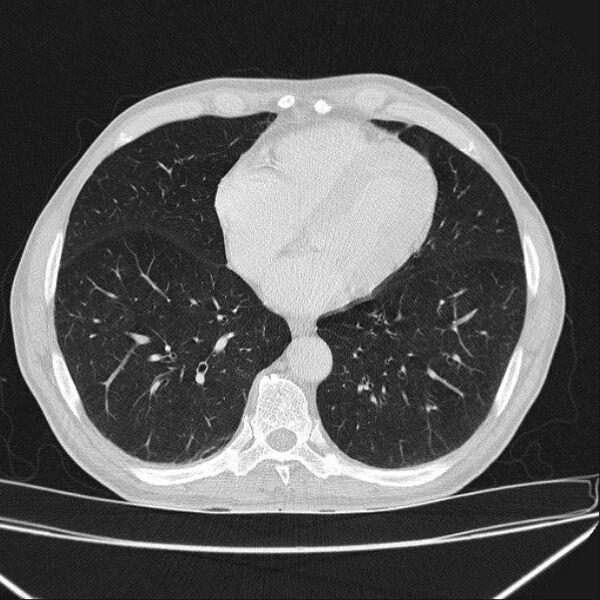 File:Azygos lobe (Radiopaedia 38259-40275 Axial lung window 57).jpg