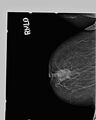 BIRADS V lesion (Radiopaedia 24039-24250 A 1).jpg