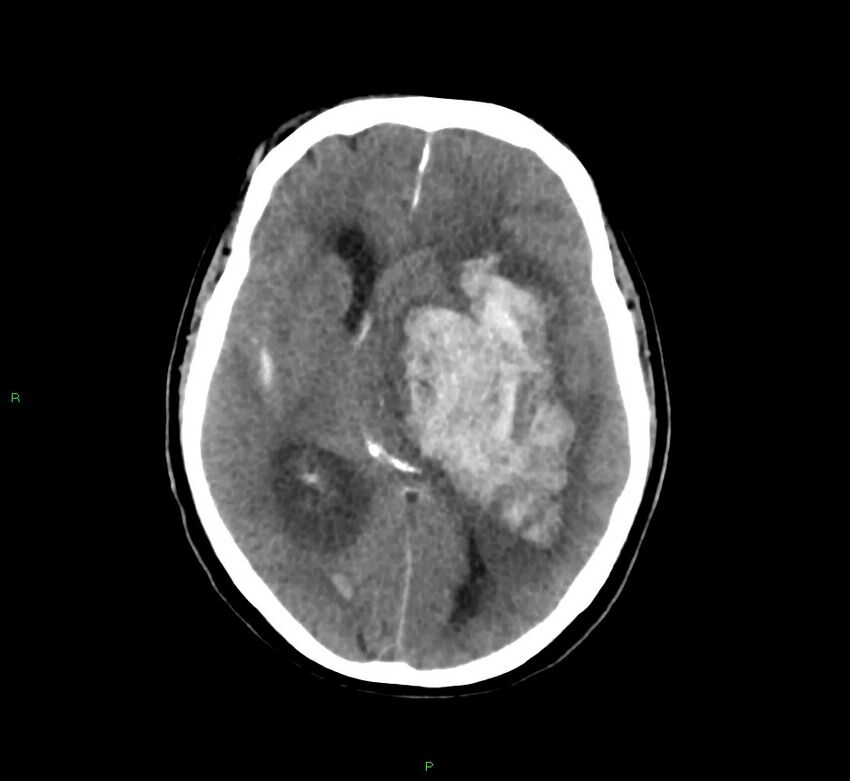 Basal ganglia hemorrhage (Radiopaedia 58775-66008 Axial non-contrast 33).jpg