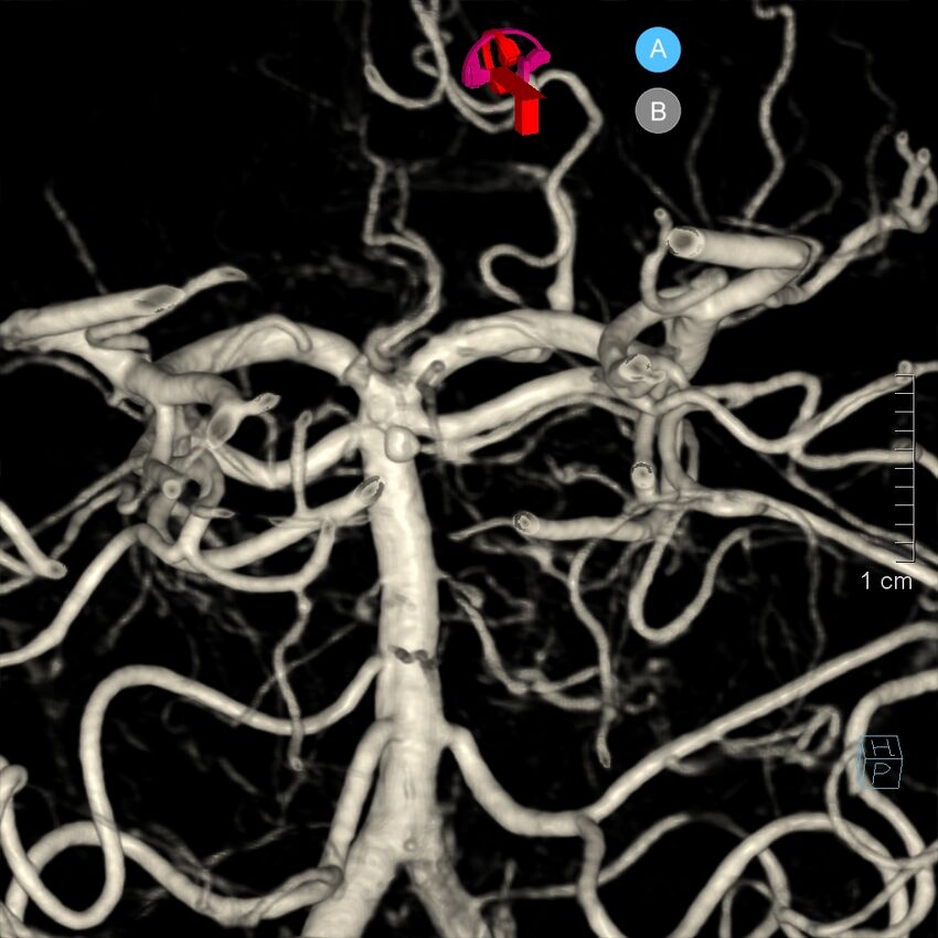 Basilar artery perforator aneurysm (Radiopaedia 82455-97734 3D view left VA 161).jpg