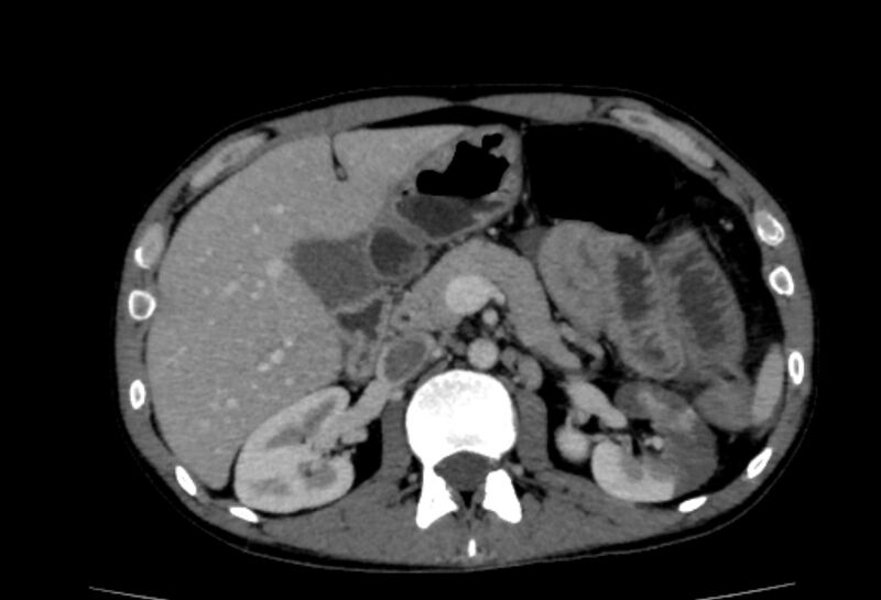 File:Behçet's disease- abdominal vasculitis (Radiopaedia 55955-62570 A 25).jpg