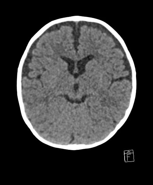 File:Benign enlargement of subarachnoid spaces in infancy (BESS) (Radiopaedia 87459-103795 Axial non-contrast 50).jpg