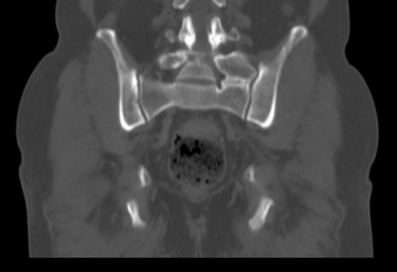 File:Bertolotti syndrome (Radiopaedia 58974-66235 Coronal bone window 13).jpg