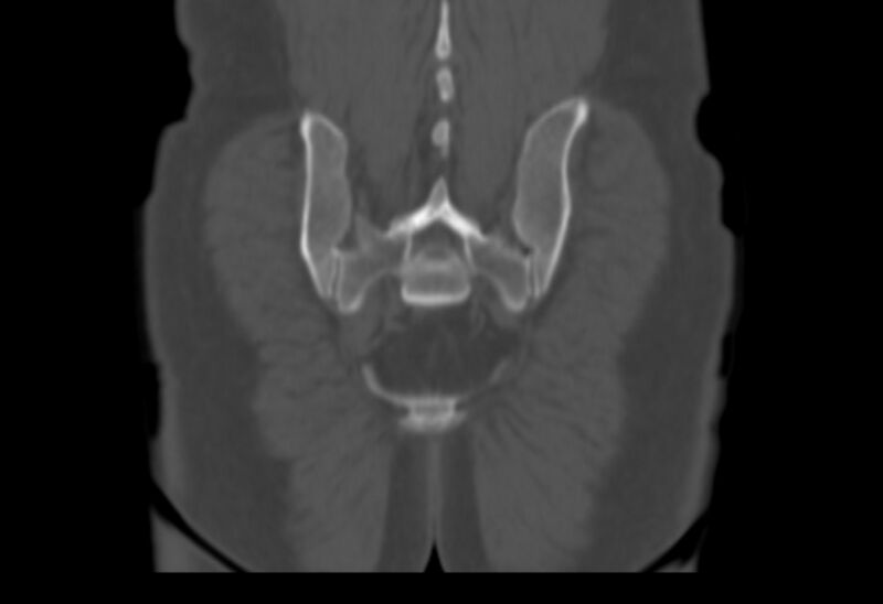 File:Bertolotti syndrome (Radiopaedia 58974-66235 Coronal bone window 4).jpg