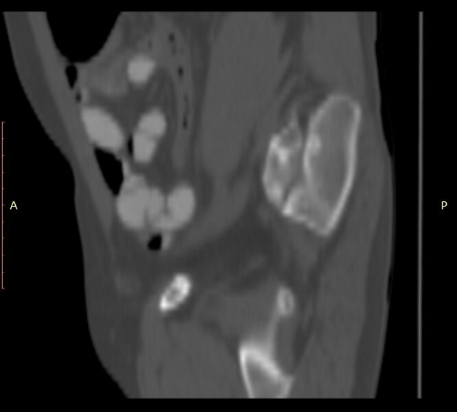 File:Bertolotti syndrome (Radiopaedia 58974-66235 Sagittal bone window 52).jpg