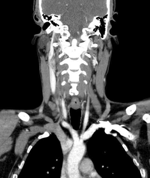 File:Bilateral carotid body tumors (Radiopaedia 52899-58827 B 34).jpg