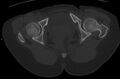 Bilateral mature cystic ovarian teratoma (Radiopaedia 88821-105592 Axial bone window 53).jpg