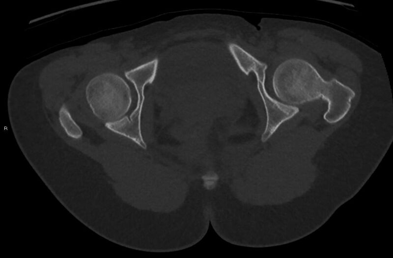 File:Bilateral mature cystic ovarian teratoma (Radiopaedia 88821-105592 Axial bone window 53).jpg