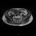 Bilateral ovarian fibroma (Radiopaedia 44568-48293 Axial T2 7).jpg