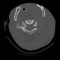 Bilateral perched facets with cord injury (Radiopaedia 45587-49713 Axial bone window 31).jpg