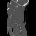 Bilateral perched facets with cord injury (Radiopaedia 45587-49713 Sagittal bone window 10).jpg