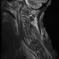 Bilateral perched facets with cord injury (Radiopaedia 45587-49714 Sagittal STIR 14).jpg
