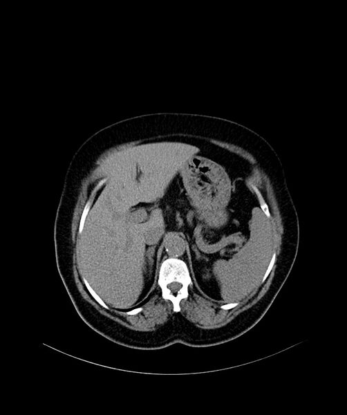 File:Bilateral sporadic synchronous clear cell renal cell carcinoma (Radiopaedia 85035-100572 Axial non-contrast 15).jpg